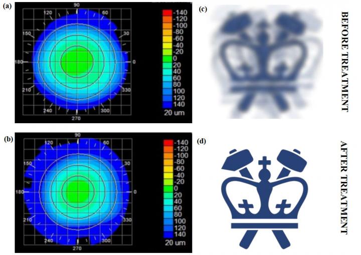 Columbia Engineers Invent a Noninvasive Technique to Correct Vision