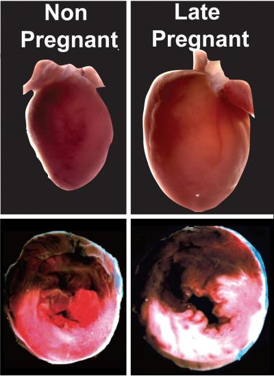 Heart Attack during Late Pregnancy