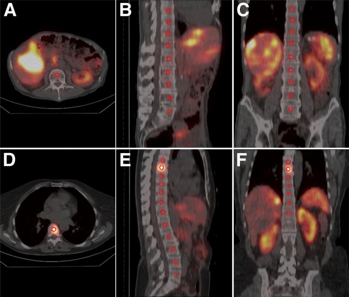 Location of Spheric Volume of Interests in Vertebrae