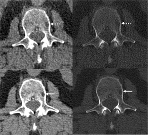 Novel Photon-Counting CT Improves Myeloma Bone Disease Detection