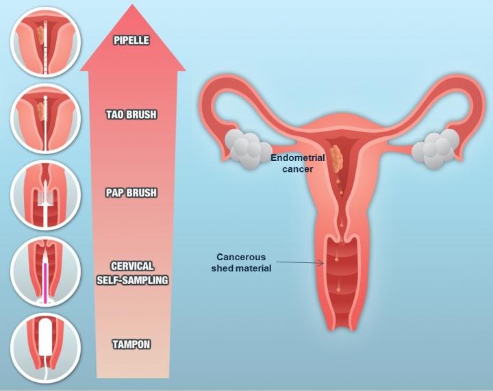 Endometrial Cancer [IMAGE] | EurekAlert! Science News Releases