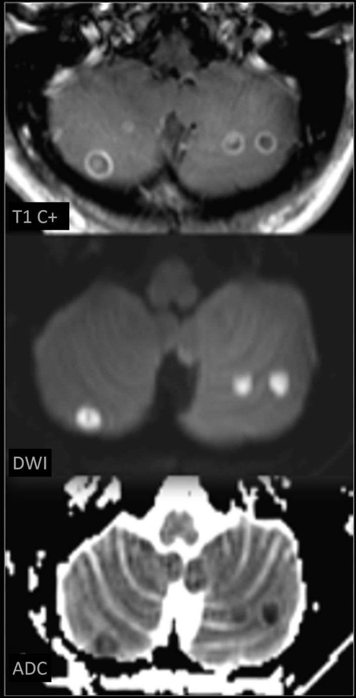 Emergency Radiologists See Inner Toll of Opioid Use Disorders (2 of 3)