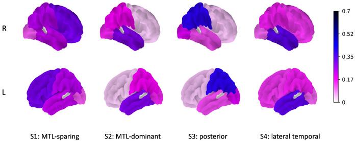 Right and left hemisphere brain surface plots showing the strength of the canonical vector, νƙ, for each subtype.