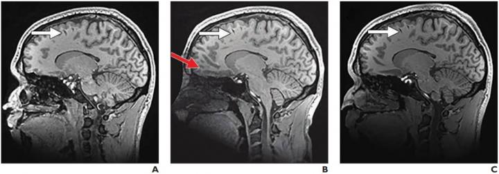 Magnetization-prepared rapid acquisition with gradient-echo (MPRAGE) images of 25-year-old healthy female participant.