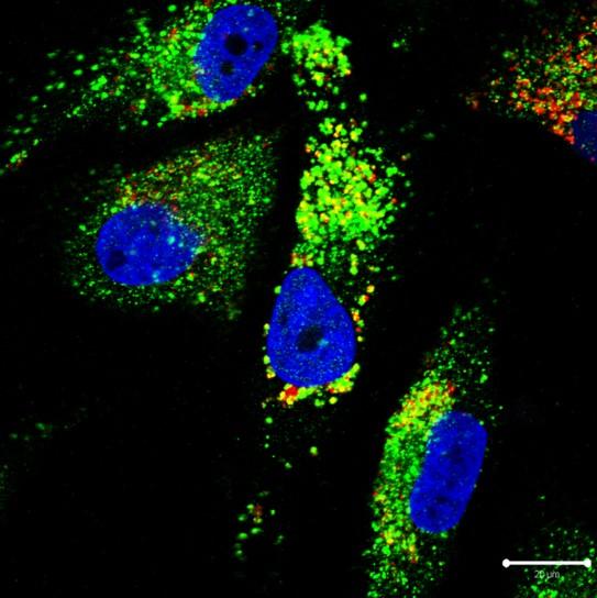 Fig. 1. Lung Adenocarcinoma Cells