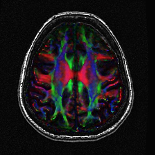 fMRI Brain Scan
