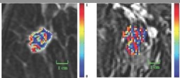 Imaging Analysys Holds Promise as a Faster, Cheaper Prognostic Test for ER-positive Breast Cancer