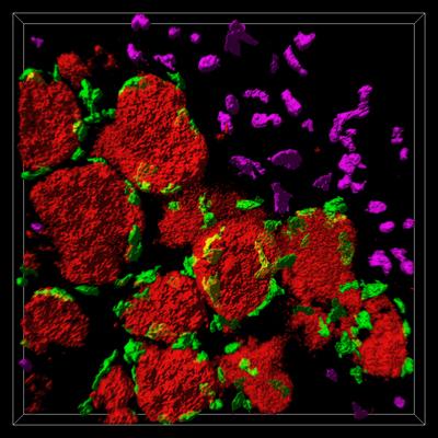 Confocal Microscope Image of a Spontaneous Breast Cancer Tumor in a Mouse