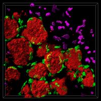 Confocal Microscope Image of a Spontaneous Breast Cancer Tumor in a Mouse