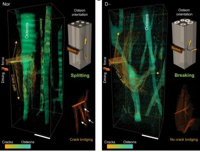 Vitamin D Deficiency and Bones