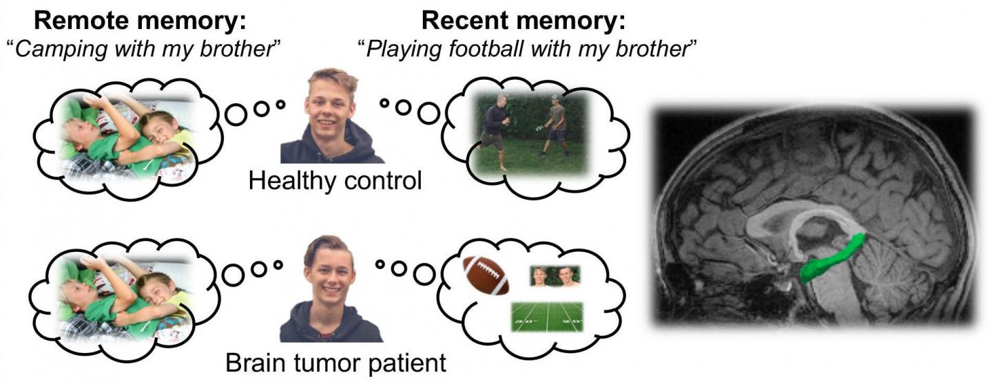Radiotherapy Impacts Memory