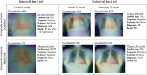 Researchers Use AI to Triage Patients with Chest Pain