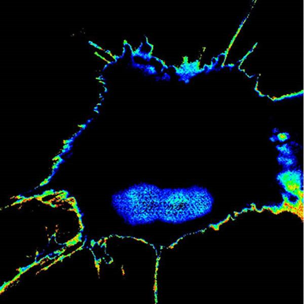 Tumor Cell with Potential Metastasis, UC San Diego School of Medicine