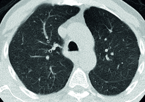 Chest CT showing healthy lungs