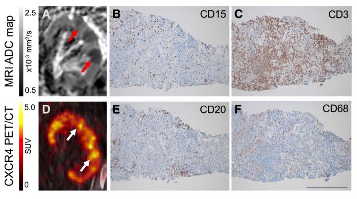 Renal Leukocyte Infiltration in PET and MR Imaging