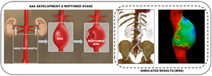 AAA development and ruptured stage and simulated results