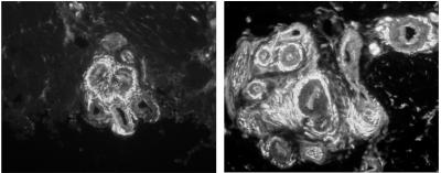 Excess Total Nerve Fibers around Shunts in Fibromyalgia Patients
