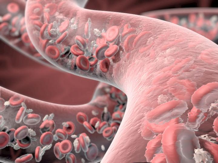 Antiplatelet Drug Busts Blood Clots While Cutting Bleeding Risk