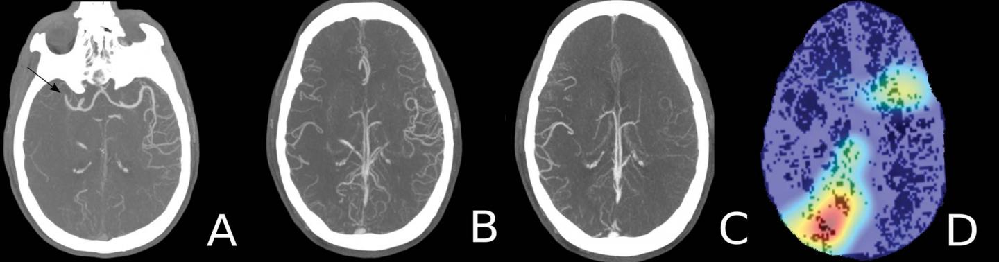 Deep Learning Model Provides Rapid Detection of Stroke-causing Blockages