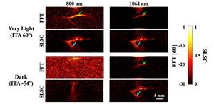 Photoacoustic images of a splayed vessel structure underlying very light and dark skin tones, created with an amplitude-based fast Fourier transform (FFT) reconstruction and short-lag spatial coherence (SLSC) beamforming.