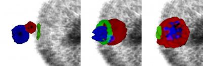 Malaria Parasite Invades a Blood Cell (Super Resolution Microscopy)