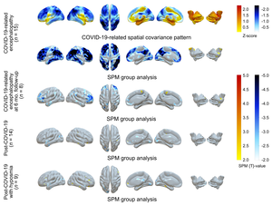 F-18 FDG PET in COVID-19–related CNS disorders