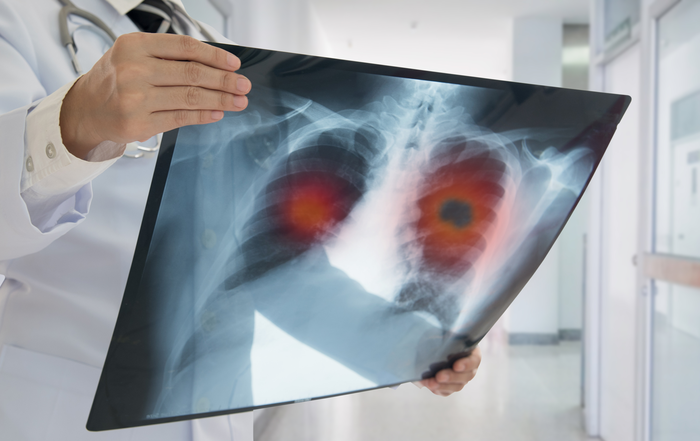 Lung cancer screening