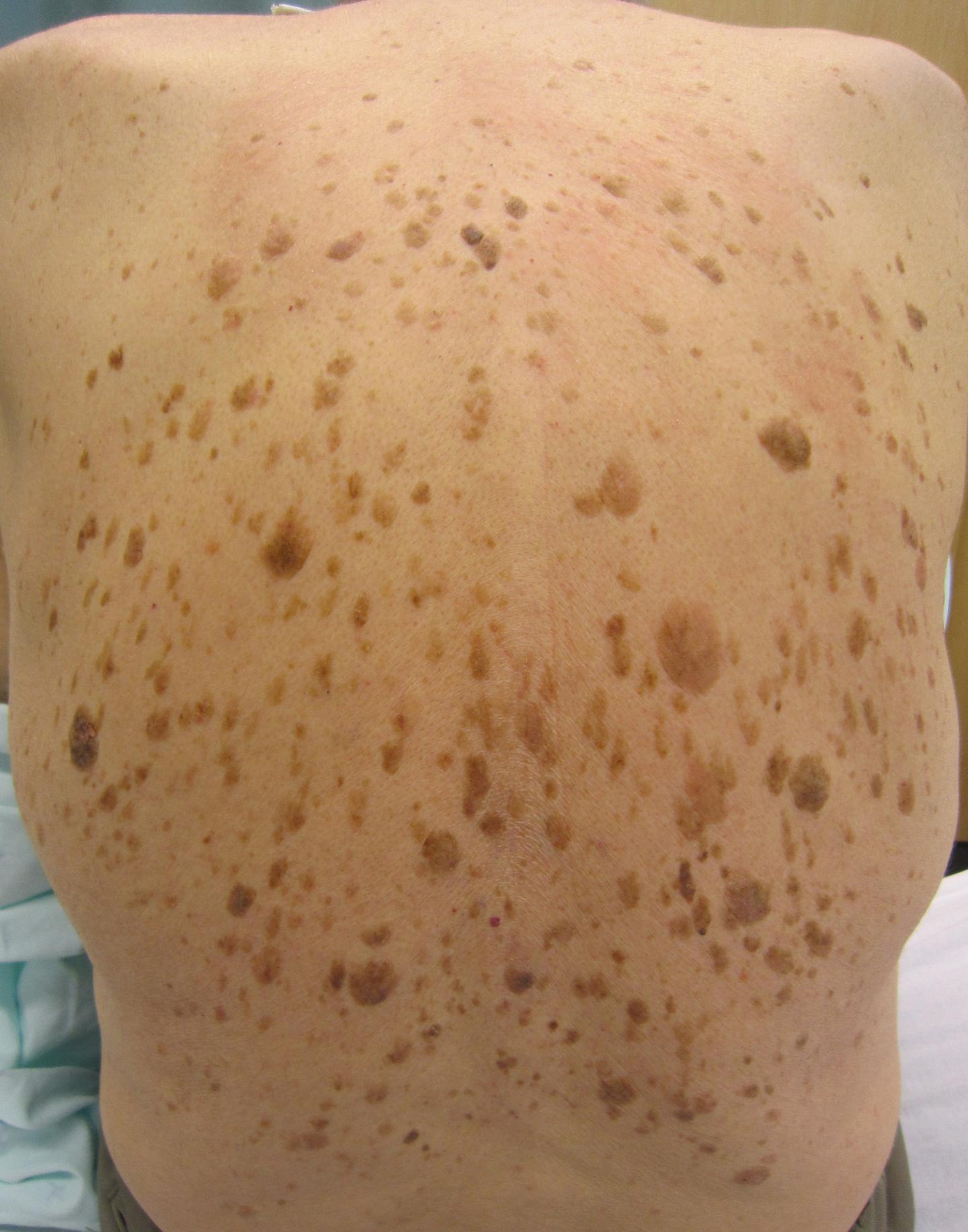 Seborrheic keratosis lesions