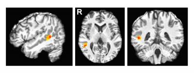 fMRI of Subject Recognizing a Facial Expression