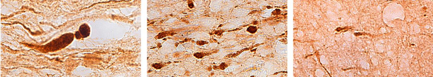 Brain Cells Reveal Different Types of Traumatic Injuries