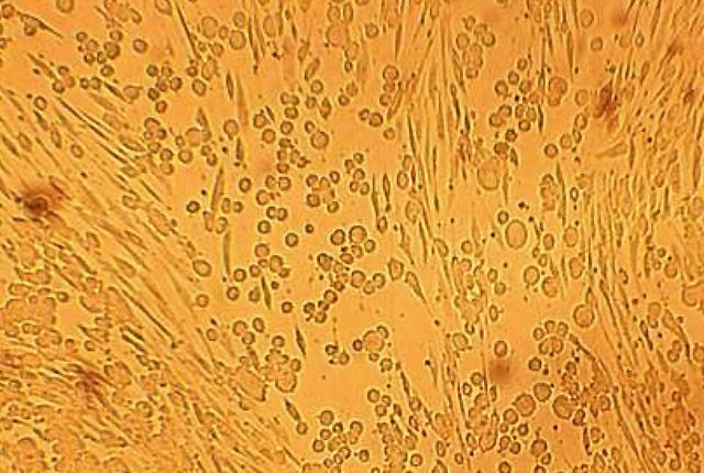 Herpes Simplex Virus