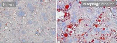 Autophagy Impaired