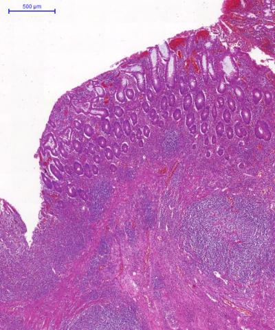 T Cells in Inflammatory Bowel Disease (1 of 2)