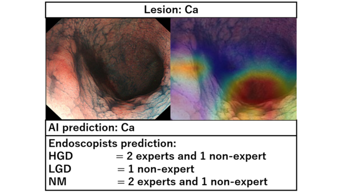 A newly developed AI model classifies IBDN lesions based on images derived from patients with IBD, with higher accuracy than that of endoscopists