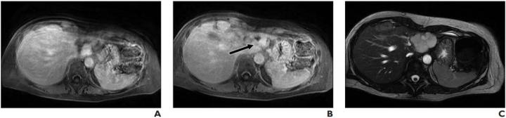 56-Year-Old Woman With Benign Hemangioma