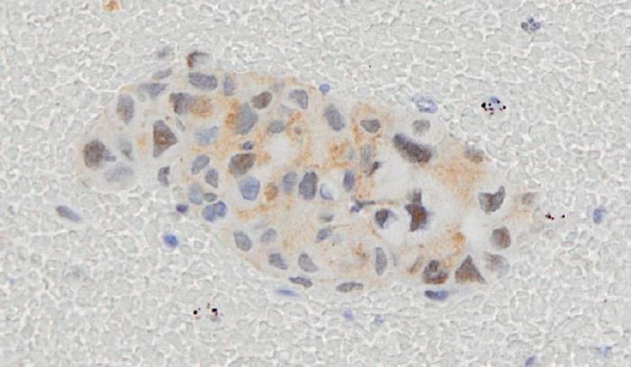 Lung cancer cells