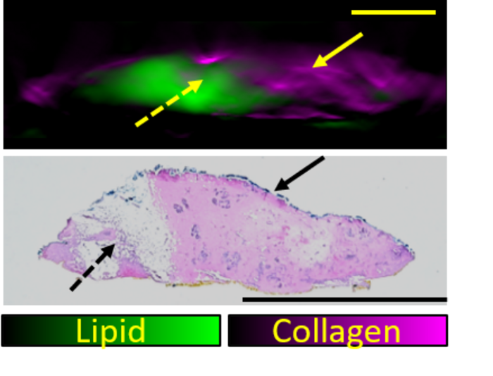 How Optoacoustic Imaging Plays a Role in Assessing the Success of Breast Cancer Surgery