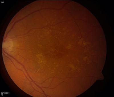Retina with Macular Degeneration