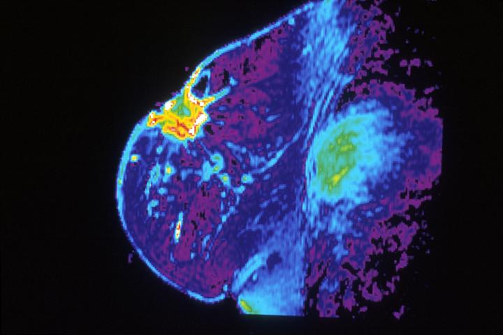 Lesion on Breast MRI