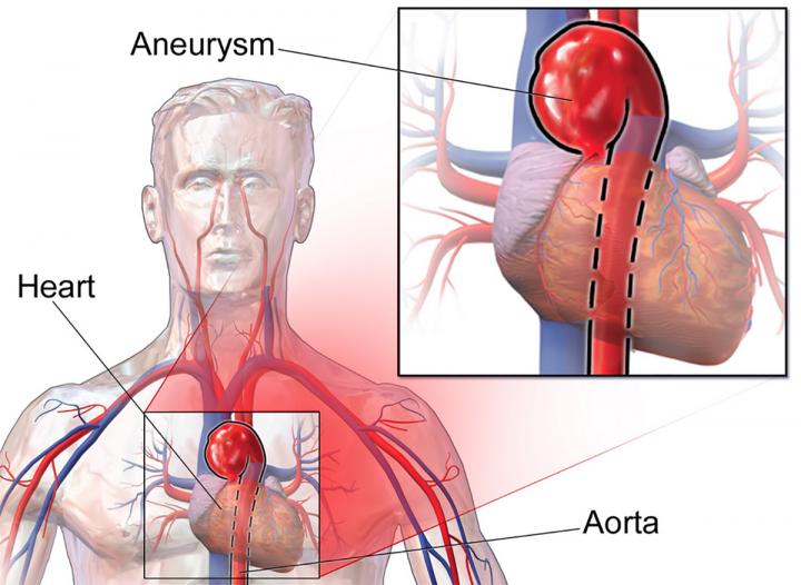 Genetic Error that Increases Risk of Aortic Rupture Identified