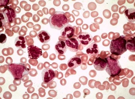 CML Blood Cells