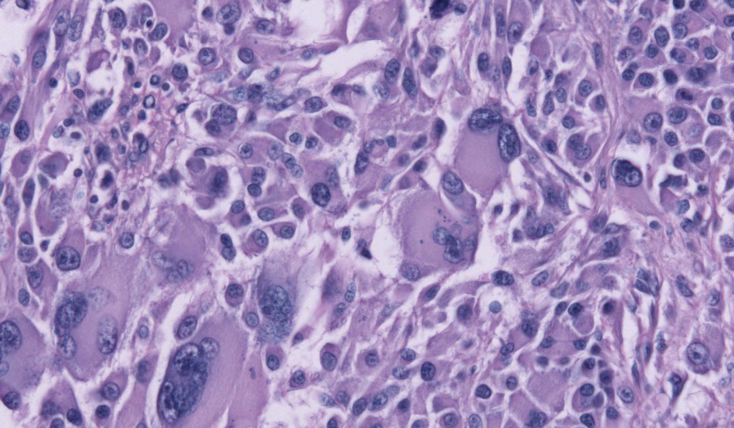 Glioblastoma
