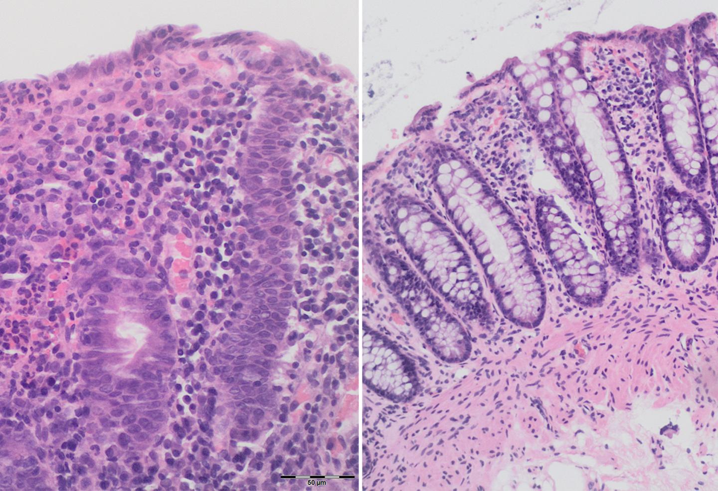 Light Therapy for Immune Cells Helps with Side Effects of Cancer Therapy (2 of 2)