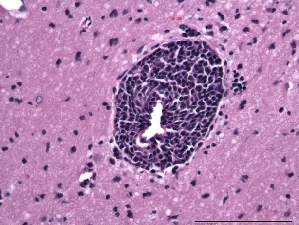 Unique Pattern of Brain Inflammation