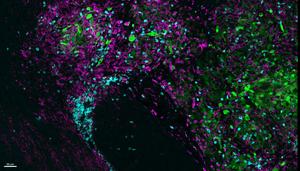 Killer T cells, glioblastoma, and microglia