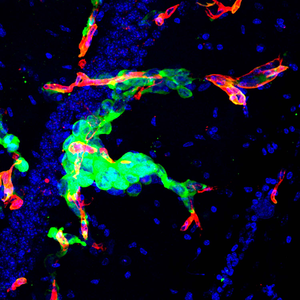 Image of metastasis in a mouse brain.