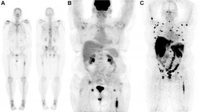 Lesion Targeting with 89Zr-IAB2M in Patient with Metastatic Prostate Cancer