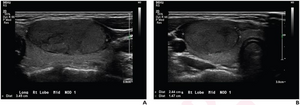 TI-RADS, Algorithm Guide Diagnoses of Pediatric Thyroid Nodules on Ultrasound