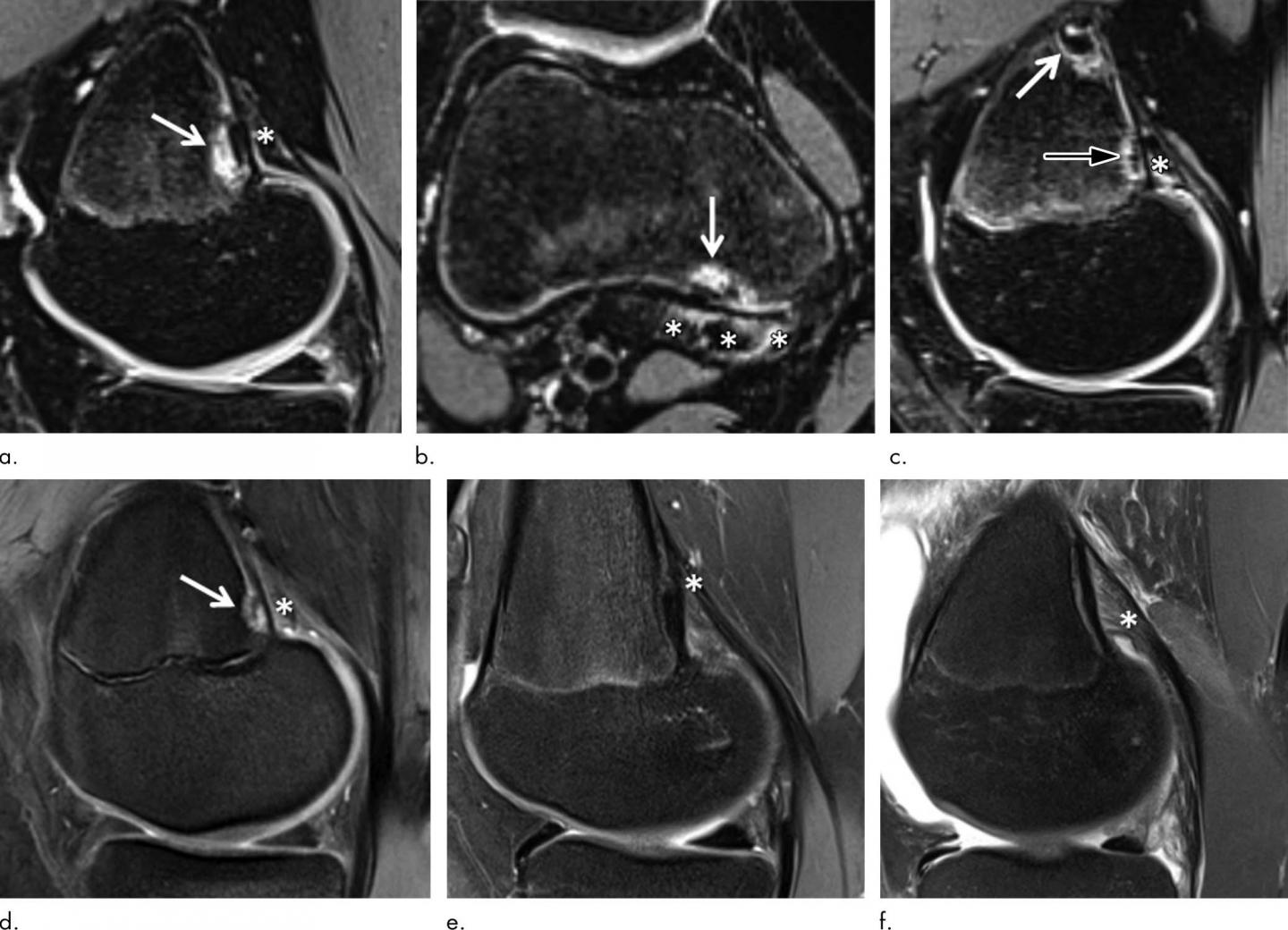 Irregular Findings Common in Knees of Young Competitive Alpine Skiers