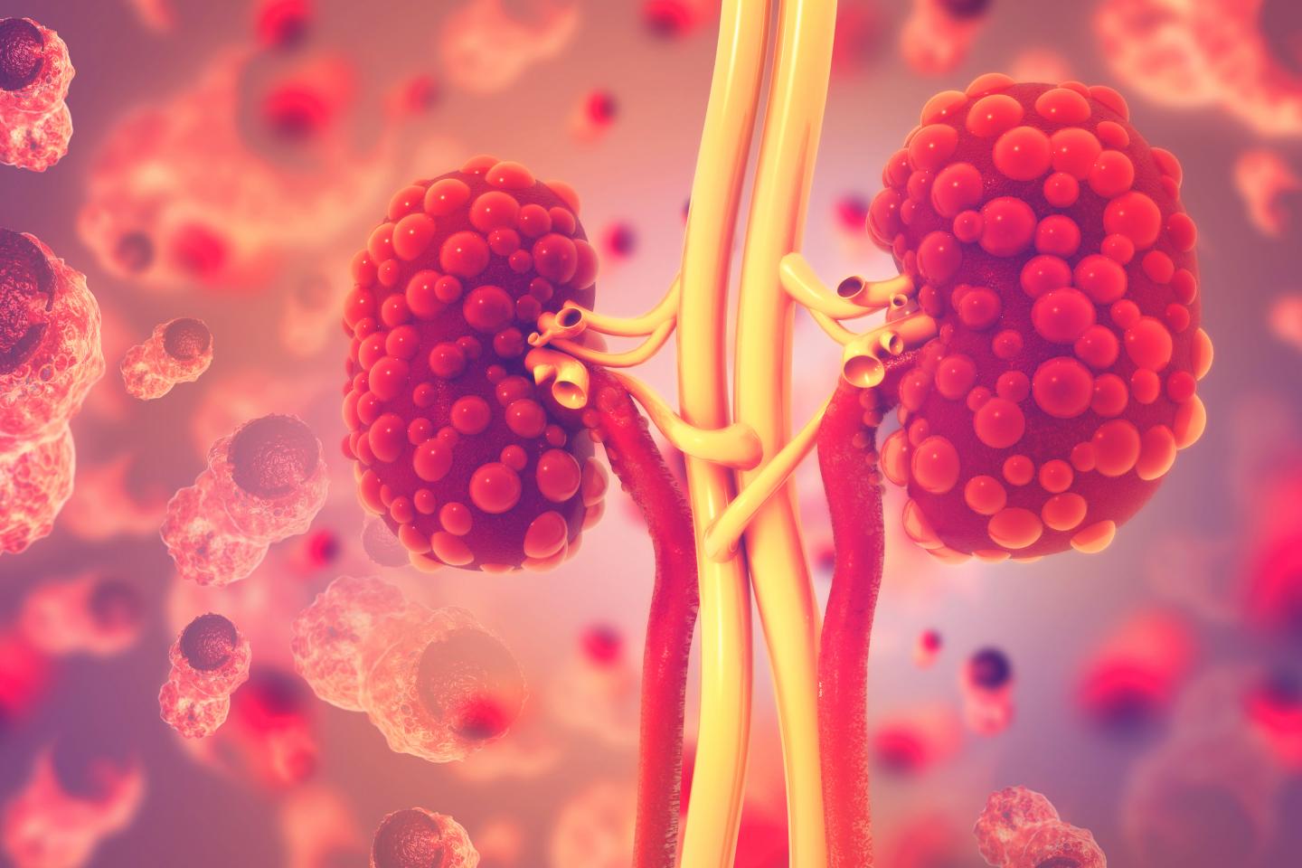 Chronic kidney disease